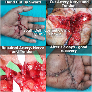 Hand Cut injury surgery