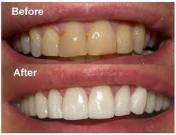 natural teeth whitening