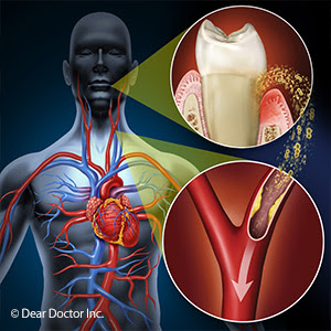 implant-dentist-sydney-is-there-a-link-between-gum-disease-and-cardiovascular-health