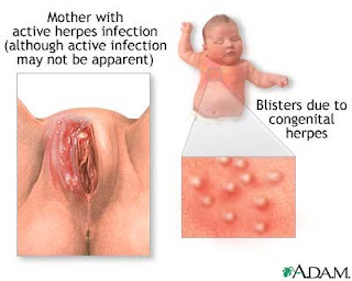 Treat Herpes During Pregnancy : Going For The Herpes Treatment That Is Naturally Effective