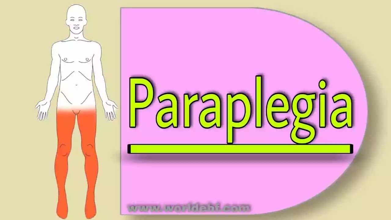 paraplegia