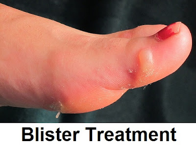 blisters causes, symptoms and treatment | blisters on feet, foot, hands, toe