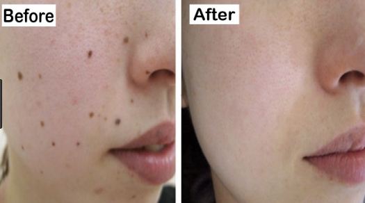 4 Home Remedies to Remove Moles at Home - Beauty Tips