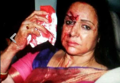 Hema Malini, BJP MP Hema Malini, Hema Malini Injured, Hema Malini accident, Dausa, Jaipur, Fortis hospital Jaipur