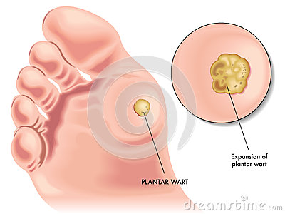 {Cara Pengobatan Penyakit Kutil Kelamin|Obat Penyakit Kelamin Seperti Kutil|Gambar Kutil Di Kemaluan Pria|Foto Kutil Di Anus|Opasnost Kondiloma|Virus Penyebab Kondiloma Akuminata|Kutil Kelamin Condyloma Acuminata|Kutil Kelamin Yang Masih Kecil|Petua Hilangkan Ketuat Kemaluan|Kondiloma Pada Pria|Obat Kutil Di Daerah Anus|Menghilangkan Kutil Kemaluan|Kutil Kelamin Pada Ibu Hamil|Cara Menghilangkan Ketuat Kelamin|Kutil Kelamin Saat Hamil|Gambar Penyakit Kutil Kemaluan|Lidah Buaya Obat Kutil Kelamin|Krim Untuk Kutil Kelamin|Apa Itu Hpv Test|Berbahayakah Kutil Kelamin|Obat Alami Kutil Jengger Ayam|Kutil Kelamin Berdarah|Obat Kutil Kelamin Yang Di Jual Di Apotek|Kutil Kelamin Gejala Hiv|Kutil Kelamin Tidak Gatal|Apa Itu Hpv Pada Pria|Cara Menyembuhkan Kutil Kelamin Dengan Alami|Kutil Kelamin Dengan Cuka Apel|Obat Apotik Untuk Kondiloma Akuminata|Kutil Kelamin Sering Kambuh|Gejala Penyakit Kutil Kelamin Pria|Obat Kondiloma Untuk Ibu Hamil|Obat Alami Kutil Kelamin Obat Alami Kutil Kelamin|Apakah Kutil Kelamin Bisa Sembuh Sendiri|Kutil Kelamin Dapat Sembuh Sendiri|Ciri Condyloma|Cara Mengatasi Penyakit Hpv|Kutil Kelamin Di Laser|Apotik Jual Obat Kutil Kelamin|Apa Itu Injection Hpv|Mengobati Kutil Pada Kelamin|Menghilangkan Hpv|Gambar Kutil Kelamin Tahap Awal|Bagaimana Cara Penyembuhan Kutil Kelamin|Mengenali Gejala Kutil Kelamin|Gejala Penyakit Ketuat Kemaluan|Kutil Kelamin Di Buah Zakar|Gambar Kutil Di Anus|Gejala Hpv|Penyebab Kutil Kelamin Pada Wanita|Gambar Gambar Kutil Kelamin|Kutil Kelamin Cara Mengobati|Pengobatan Kutil Kelamin Di Rumah|Efek Kondiloma Pada Janin|Obat Kutil Kelamin Di Jogja|Human Papillomavirus Hpv Prevention|Cara Mengobati Penyakit Kondiloma Akuminata|Obat Kutil Wajah Alami|Apa Itu Hpv Virus|Kutil Kelamin Di Lidah|Kumpulan Obat Kutil Di Wajah|Pantangan Makan Untuk Penyakit Kutil Kelamin|Cara Menghilangkan Penyakit Kutil Kelamin|Apa Itu Virus Kondiloma|Ciri Penyakit Jengger Ayam|Obat Kutil Untuk Wajah|Penyakit Kutil Kelamin Pada Perempuan|Penyakit Kutil Kelamin Apakah Berbahaya|Obat Kutil Scara Alami|Apa Itu Kondiloma Lata|Kutil Kelamin Cara Penyembuhan|Obat Ketuat Kemaluan Tanpa Operasi|Cara Alami Mengobati Kutil Kelamin Pria|Apakah Kutil Kelamin Dapat Sembuh Total|Apakah Virus Hpv Bisa Sembuh Total|Obat Oles Kondiloma|Kondiloma Di Mulut|Crystal X Bisa Mengobati Kutil Kelamin|Pengobatan Hpv Pria|Kutil Kelamin Bagi Ibu Hamil|Nama Salep Buat Kutil Kelamin|Apakah Jengger Ayam Menular|Cara Mengobati Kutil Kelamin Dengan Bahan Alami|Cara Mengobati Kutil Kelamin Pada Wanita Hamil|Obat Alami Untuk Kutil Kemaluan|Nama Obat Kutil Di Kelamin|Penyebab Kondiloma Pada Wanita|Penyebab Kutil Pada Kemaluan Wanita|Bagaimana Cara Menghilangkan Kutil Kelamin|Obat Kutil Kelamin Yg Ada Di Apotik|Obat Kutil Kelamin Medis|Gambar Kutil Kelamin Condiloma|Salep Untuk Jengger Ayam|Cara Mengobati Kutil Kelamin Pria|Foto Kutil Kelamin Pada Wanita|Ketuat Di Kemaluan Wanita|Mengobati Kutil Kelamin Dengan Cuka Apel|Bakteri Penyebab Kutil Kelamin|Cara Mengobati Kutil Kemaluan Dengan Bawang Putih|Apa Yang Dimaksud Kondiloma Akuminata|Gambar Penyakit Hpv|Gambar Kutil Kelamin Perempuan|Kondiloma Adalah Penyakit|Obat Kutil Kelamin Di Semarang|Human Papillomavirus Hpv Pictures|Kondiloma Akuminata Pada Wanita Hamil|Pengobatan Kutil Kelamin Dokter|Gambar Penyakit Jengger Ayam|Obat Kutil Genital|Cara Menghilangkan Kutil Kelamin Alami|Obat Alami Atasi Kutil Kelamin|Kutil Di Kemaluan|Beli Obat Jengger Ayam|Apa Arti Kondiloma|Obat Alami Untuk Menghilangkan Kutil Kelamin|Apa Itu Penyakit Kondiloma Akuminata|Obat Kutil Kelamin Murah|Obat Penyakit Kutil Kelamin|Kutil Kelamin Warna Hitam|Cara Menyembuhkan Kutil Di Kelamin Secara Alami|Obat Kutil Atau Mata Ikan|Ketuat Kemaluan Lelaki|Obat Penyakit Kutil Kelamin Di Apotik|Obat Resep Dokter Untuk Kutil Kelamin|Obat Herbal Kutil Kelamin Wanita|Cara Mengobati Penyakit Kutil Pada Kelamin Pria|Apakah Kutil Kelamin Bisa Sembuh|Ketuat Di Kemaluan|Apotik Yang Menjual Obat Kutil Kelamin|Salep Mengobati Kutil Kelamin|Obat Kutil Untuk Di Muka|Cara Mengobati Kutil Kelamin Secara Alami|Ciri Ciri Penyakit Kutil Pada Kelamin Pria|Penyebab Penyakit Kutil Pada Kelamin Pria|Kondiloma Di Dubur|Cara Merontokan Kondiloma|Obat Cina Untuk Kutil Kelamin|Pengobatan Kutil Kemaluan|Nama Penyakit Kutil Kelamin|Apakah Kutil Kelamin Berbahaya|Bagaimana Cara Menghilangkan Virus Hpv|Kondiloma Pada Persalinan|Obat Antibiotik Untuk Kutil Kelamin|Penyakit Kutil Kelamin Bisa Sembuh|Obat Kutil Alami Yang Ampuh|Gambar Kutil Kelamin Wanita|Gejala Penyakit Kutil Kelamin Pada Wanita|Obat Kimia Untuk Kutil Kelamin|Gambar Obat Kutil|Nama Obat Untuk Kutil Kelamin Di Apotik|Salep Kutil Kelamin Yang Dijual Diapotik|Dampak Kondiloma Akuminata Pada Janin|Kutil Kelamin Propolis|Obat Kutil Pada Tangan|Apakah Hpv Bisa Sembuh Total|Gambar Gejala Awal Kutil Kelamin|Obat Kutil Kelamin Di Bali|Obat Kutil Dari Dalam|Obat Menghilangkan Kutil Di Anus|Obat Untuk Menghilangkan Ketuat|Kutil Kelamin Bisa Sembuh Dengan Sendirinya|Pengobatan Alternatif Virus Hpv|Obat Salep Kondiloma Akuminata|Obat Kutil Apa|Obat Kutil Air|Obat Herbal Kutil Di Anus|Obat Kutil Hpv|Penyebab Penyakit Kondiloma Akuminata|Bahaya Kutil Kelamin Pada Ibu Hamil|Cara Alami Obat Kutil Kelamin|Kumpulan Obat Kutil Kelamin Di Apotik|Obat Penyakit Kutil Kelamin Pria|Obat Medis Untuk Kutil Kelamin|Kutil Kelamin Seperti Apa|Kutil Kelamin Obat Alami|Kutil Kelamin Bisa Disembuhkan Atau Tidak|Bahan Obat Kutil Kelamin|Mengatasi Kutil Pada Kelamin|Obat Kutil Di Wajah|Herpes Genital Dan Penyakit Kutil Kelamin|Obat Kutil Di Jari Tangan|Obat Kondiloma Kutil Kelamin Jengger Ayam|Obat Kutil Jengger|Menghilangkan Kutil Di Kemaluan Wanita|Cara Menghilangkan Kutil Kelamin Pria Secara Alami|Cara Menyembuhkan Ketuat Kelamin|Cara Mengobati Kutil Kelamin Sendiri|Nama Salep Kutil Kelamin Di Apotik|Kutil Kelamin Bawang Putih|Cara Menghilangkan Kutil Kemaluan Dengan Bawang Putih|Obat Menghilangkan Kutil Di Leher|Kutil Kelamin Masih Kecil|Kutil Kelamin Bisa Sembuh Sendiri|Kutil Kelamin Sembuh Dengan Bawang Putih|Penyebab Kutil Kelamin Perempuan|Penyebabnya Kutil Kelamin|Nama Salep Kutil Kelamin|Penyebab Terjadinya Penyakit Kutil Kelamin|Kutil Kelamin Yang Tidak Gatal|Obat Kutil Dan Mata Ikan|Cara Mengobati Kutil Kelamin Pd Wanita|Pengobatan Kondiloma Pada Pria|Berapa Lama Pengobatan Kutil Kelamin|Pengobatan Alternatif Hpv|Kumpulan Obat Penyakit Kondiloma|Menyembuhkan Kondiloma|Cara Mengatasi Kutil Pada Kelamin Pria|Apakah Kutil Kelamin Menyebabkan Keputihan|Cara Menyembuhkan Kutil Kemaluan|Obat Kutil Obat Kutil|Penyebab Ada Nya Kutil Kelamin|Cara Menghilangkan Virus Kutil Kelamin|Kondiloma Bisa Hilang Sendiri|Cara Menghilangkan Kutil Pada Alat Kelamin|Kondiloma Penyakit Apa|Obat Alami Untuk Kutil Di Kelamin|Kondiloma Pada Laki Laki|Cara Menghilangkan Kutil Di Anus|Pengobatan Alami Penyakit Kutil Kelamin|Obat Ampuh Ngilangin Kutil|Obat Salep Buat Kutil Kelamin|Penyebab Dan Gejala Penyakit Kutil Kelamin|Masa Penularan Kutil Kelamin|Obat Kutil Kelamin Tradisional Yang Ampuh|Cream Perontok Hpv|Menghilangkan Kutil Kelamin Dengan Kulit Pisang|Obat Luar Kutil|Apa Suntikan Hpv|Cara Menghilangkan Kutil Di Bagian Kelamin|Gambar Kutil Kemaluan Wanita|Kondiloma Akuminata Pada Kehamilan|Obat Kutil Kelamin Dengan Cuka|Kutil Di Dalam Anus|Kutil Kelamin Bisa Hilang|Obat Tradisional Penghilang Kutil Kelamin|Apakah Kondiloma Akuminata Bisa Sembuh|Apakah Penyakit Kutil Kelamin Berbahaya|Harga Obat Jengger Ayam|Gambar Ketuat Di Kemaluan|Pantangan Untuk Penyakit Kutil Kelamin|Salep Untuk Menghilangkan Kutil Kelamin|Salep Untuk Mengobati Kutil Kelamin|Gejala Klinis Pada Penyakit Kondiloma Akuminala|Obat Kutil Kelamin Ampuh|Jual Obat Ketuat Kemaluan|Tanaman Obat Untuk Menghilangkan Kutil Kelamin|Harga Salep Kutil Kelamin|Obat Kutil Hansaplast|Obat Kutil Farmasi|Faktor Penyebab Kondiloma Akuminata|Obat Kutil Di Venis|Cara Alami Mengobati Hpv|Mengobati Kutil Kelamin Dengan Lidah Buaya|Pengalaman Operasi Kutil Kelamin|Bahaya Kondiloma|Pengobatan Ketuat Kemaluan Pria|Obat Kutil Kelamin Murah Meriah|Obat Kutil Cream|Kutil Kelamin Obat Nya|Pengobatan Alternatif Jengger Ayam|Fakta Kutil Kelamin|Apa Itu Kutil Kemaluan|Cara Menghilangkan Bekas Kutil Kelamin|Kutil Kelamin Yang Baru Muncul|Penyebab Penyakit Kutil Kemaluan|Obat Kutil De Nature Indonesia|Obat Kutil Secara Medis|Obat Tradisional Kutil Di Anus|Apakah Kondiloma Bisa Sembuh|Menghilangkan Kutil Kelamin Dengan Kapur|Mengobati Kutil Kelamin Tradisional|Bentuk Kondiloma Akuminata|Gambar Kutil Kelamin Kesehatan|Berapa Harga Operasi Kutil Kelamin|Pengobatan Penyakit Kutil Kelamin Pada Pria|Apakah Kutil Kelamin Itu Berbahaya|Beda Kondiloma Lata Dan Akuminata|Kutil Dalam Anus|Pengobatan Alternatif Kutil Kelamin|Apa Yang Dimaksud Dengan Kondiloma Akuminata|Foto Obat Kutil|Testimoni Kondiloma|Gejala Gejala Klinis Penyakit Kondiloma Akuminala|Obat Kutil Jengger Ayam|Apakah Kondiloma Bisa Hilang Sendiri|Nama Obat Kutil Di Apotik|Obat Kutil Sabun Colek Dan Kapur Sirih|Obat Kutil Beranak|Obat Kutil Berakar|Efek Penyakit Kutil Kelamin|Penyebab Kutil Kelamin Dan Penyembuhannya|Cream Perontok Ketuat Kemaluan|Operasi Kutil Kelamin Dengan Bpjs|Obat Herbal Kutil Kelamin|Human Papillomavirus Hpv Vaccine Side Effects|Apakah Kutil Pada Kelamin Berbahaya|Kondiloma Sembuh Sendiri|Kumpulan Obat Kutil Di Kemaluan|Nama Obat Kondiloma|Kutil Kelamin Dan Kencing Nanah|Jenis Obat Kutil Kelamin|Cara Mengobati Kondiloma|Mengobati Kutil Di Kemaluan|Obat Kondiloma De Nature|Faktor Risiko Kondiloma|Mengobati Kutil Kelamin Dengan Cuka|Gejala Gejala Kutil Kelamin|Pengobatan Kutil Kelamin Pada Ibu Hamil|Mengatasi Kutil Di Kemaluan|Penularan Penyakit Kondiloma Akuminata|Kondiloma Pada Kehamilan|Obat Tradisional Kutil Kelamin Pada Pria|Apa Itu Penyakit Kelamin Jengger Ayam|Ciri Kutil Kelamin|Obat Kutil Kelamin Dari Dalam|Jual Obat Kutil Kelamin Wanita|Cara Mengatasi Ketuat Kelamin|Cara Mengobati Kutil Kelamin Dengan Tumbuhan|Gejala Kondiloma Pada Wanita|Kutil Kelamin Dan Bawang Putih|Kutil Kelamin Tidak Bahaya|Apakah Itu Suntikan Hpv|Penyakit Kutil Pada Kemaluan Pria|Apakah Kutil Kelamin Menyebabkan Gatal|Kondiloma Pada Anak|Pengobatan Kutil Di Kelamin|Obat Kutil Pada Kemaluan Wanita|Obat Tradisional Untuk Kondiloma|Kutil Kelamin Atau Jengger Ayam|Harga Obat Ketuat Kemaluan|Terapi Kondiloma Akuminata Pada Kehamilan|Cara Cepat Menyembuhkan Kutil Kelamin|Operasi Ketuat Kemaluan|Mencegah Penyakit Kutil Kelamin|Kutil Kelamin Tumbuh Lagi|Gambar Kutil Kelamin Yang Baru Tumbuh|Obat Kutil Paling Bagus|Kutil Kelamin Dan Cara Mengatasinya|Pengobatan Kutil Kelamin|Ada Kutil Di Anus|Hpv 16 Dan 18 Adalah|Kondiloma Pada Bayi|Obat Topikal Kondiloma|Cara Mengobati Kutil Di Kemaluan Pria Dengan Bawang Putih|Operasi Kondiloma Akuminata|Cara Alami Merontokan Kutil Kelamin|Obat Virus Kutil Kelamin|Gejala Ketuat Kemaluan|Tumbuhan Obat Kutil Kelamin|Kutil Kelamin Tidak Menular|Obat Penyakit Ketuat Kemaluan|Penyebab Kutil Kelamin Dan Pengobatannya|Obat Salep Kutil Kelamin Di Apotik|Cuka Apel Untuk Menghilangkan Kutil Kelamin|Bahaya Kutil Kelamin Untuk Ibu Hamil|Kutil Kelamin Karena Wc Umum|Cara Pengobatan Kutil Kelamin Pada Wanita|Efek Samping Obat Kutil Kelamin|Obat Salep Untuk Kutil Kelamin|Jengger Ayam Bisa Disembuhkan|Menghilangkan Kondiloma|Bahaya Kutil Kelamin Jika Tidak Diobati|Cara Mengobati Kutil Di Kemaluan|Kutil Kelamin Pada Wanita Hamil|Cara Alami Mengatasi Kondiloma|Mengobati Kutil Pada Kelamin Pria|Cara Menyembuhkan Kutil Kelamin Alami|Kutil Kelamin Kambuh|Kutil Kelamin Mengecil|Obat Kutil Kelamin Jakarta|Cream Kondiloma|Kutil Kelamin Ciri Ciri|Kutil Kelamin Bahaya Atau Tidak|Cara Menyembuhkan Kutil Kelamin Dengan Cepat|Obat Tradisional Untuk Penyakit Kutil Kelamin|Kondiloma Pria|Kutil Kondiloma|Gambar Kutil Dialat Kelamin|Apakah Kondiloma Bisa Hilang|Makanan Untuk Mengobati Kutil Kelamin|Cara Menghilangkan Virus Hpv Di Dalam Tubuh|Cara Mengobati Kondiloma Secara Alami|Obat Kutil Terbaru|Obat Kutil Terbaik|Apakah Kutil Kelamin Bisa Menyebabkan Hiv|Penyebab Kondiloma Akuminata|Ketuat Pada Kemaluan|Ketuat Di Bahagian Kemaluan|Kutil Di Anus Terbaru|Pengertian Dari Penyakit Kutil Kelamin|Gambar Kutil Pada Kelamin|Gejala Pertama Kutil Kelamin|Obat Kutil Di Kemaluan Wanita|Apa Itu Tes Hpv|Obat Kutil Di Muka|Cara Menyembuhkan Penyakit Hpv|Tips Menghilangkan Kutil Di Kelamin|Obat Kutil Kemaluan Pria|Kondiloma Akuminata Youtube|Efek Kutil Kelamin Pria|Cara Mengobati Kutil Kelamin Dengan Propolis|Cara Menghilangkan Kutil Kelamin Secara Cepat Dan Alami|Gejala Kutil Kelamin Pada Laki Laki|Menghilangkan Kutil Kelamin Secara Tradisional|Apa Penyebab Penyakit Kondiloma|Penyakit Kutil Kelamin Perempuan|Bekas Operasi Kutil Kelamin|Penyebab Dan Cara Me