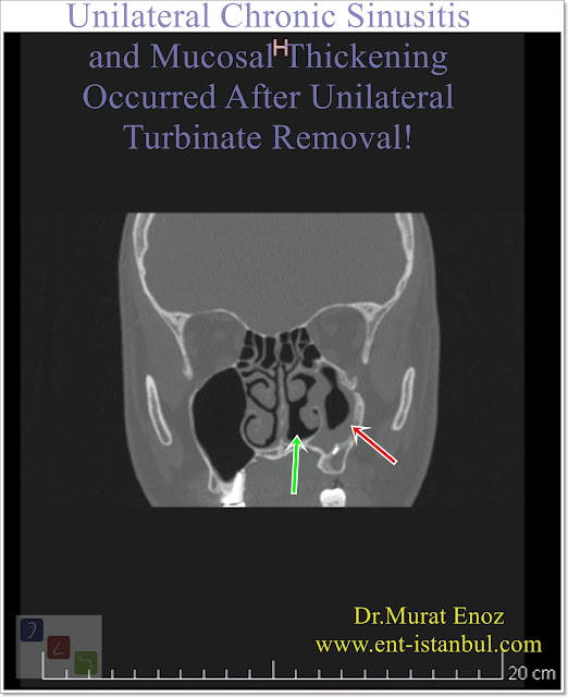 Unilateral Chronic Sinusitis and Mucosal Thickening Occurred After Unilateral Turbinate Removal!
