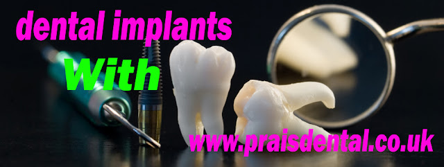 Dental Implants Treatment Is Better Than Traditional Bridgework Replacement