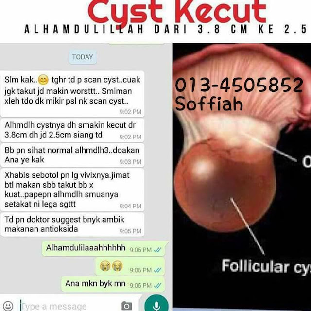 rawatan cyst dan fibroid