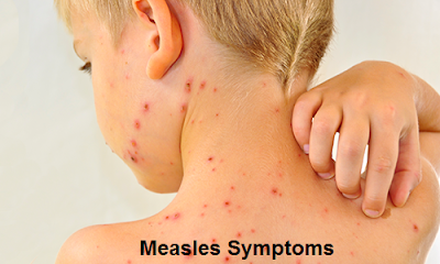 Signs-Symptoms And Treatment Of Measles In Children