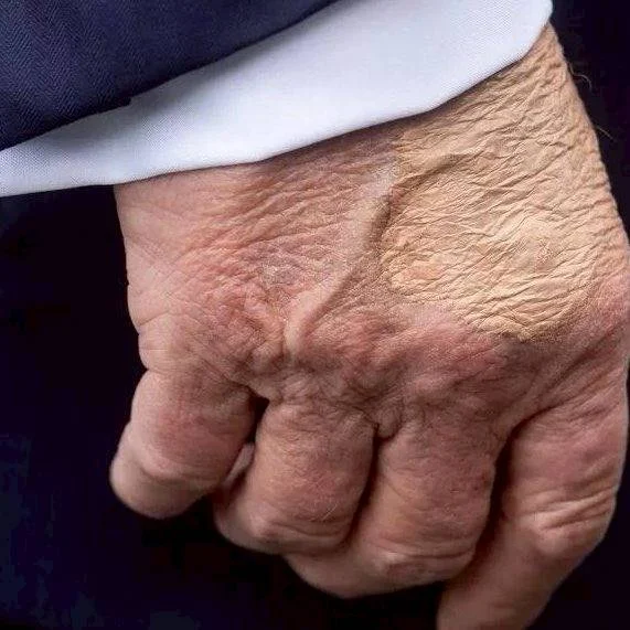 Donald Trump’s Health Under Scrutiny After Swollen Ankles and Bruised Hand—Doctors Say He's Fit to Serve