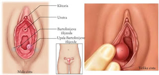 Obat Alami Untuk Penyakit Sipilis