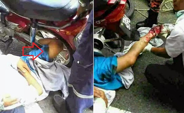 Ngeri : Detik cemas kaki pelajar 17 tahun tersepit celah lidi motosikal