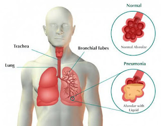 E-Book Peran Perawat Pada Anak Pneumonia