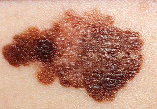 Melanoma cáncer de piel 