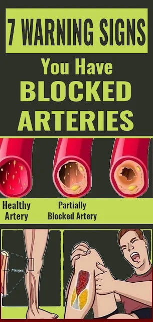 Here Are 7 Warning Signs You Have Blocked Arteries 