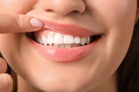 Can you rebuilt your teeth?