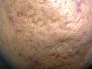 acne scars chemical peel