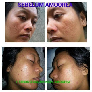 3 Testimoni sabun amoorea di Kabianggama