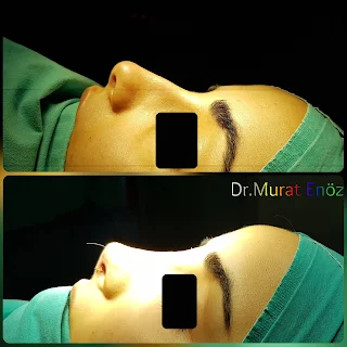 Micromotor Assisted Rhinoplasty, Nose Job Istanbul,Female Nose Aesthetic Turkey,