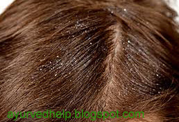 Dandruff Home Remedies