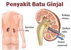 https://blogger.googleusercontent.com/img/b/R29vZ2xl/AVvXsEjGfF-U1HiYUKA6sRzoxjSHgWJHy8h4aJfDNrjzEAspG-e0cqMRkw7isO-wSCYrugOQXH_rW-t2CjqmewgJh-KgK-duQ97P34dHVA-QK9k9MYhCEMT8cBwOrhf22LPBSXDn0m_QUUsdlbE/s1600/Batu-Ginjal-ampuh.jpg