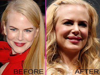 Nicole Kidman Plastic Surgery Before and After Photos