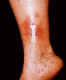 Dermatitis Stasis