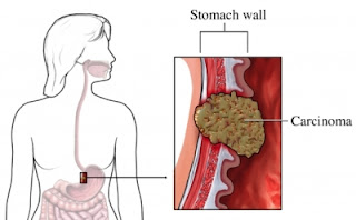 Symptomes cancer estomac 