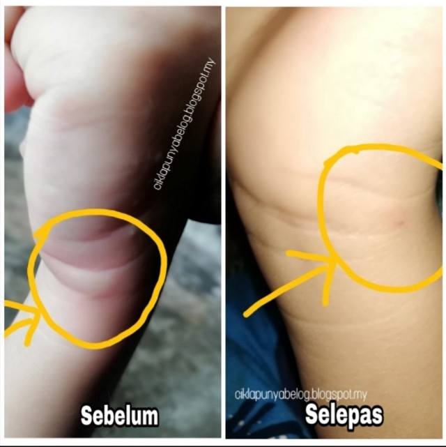 Tip hilangkan kesan gigitan nyamuk dengan mudah.