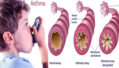 Asthma,হাঁপানি,শ্বাসরোগ