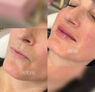 Wrinkle Reducing Injections