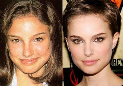 celebrity plastic surgery