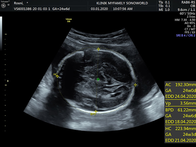 Pregnancy Journey - Buat Detail Scan di Klinik Myfamily by Mysonoworld