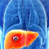 Que Es El Cáncer De Hígado: Síntomas, Diagnóstico y Tratamiento 