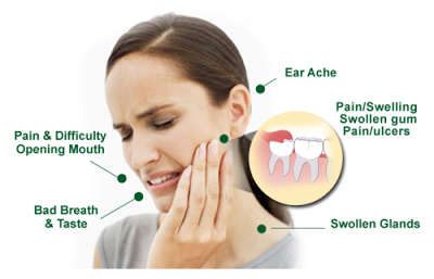 Mọc 2 răng khôn cùng lúc nguy hiểm không?