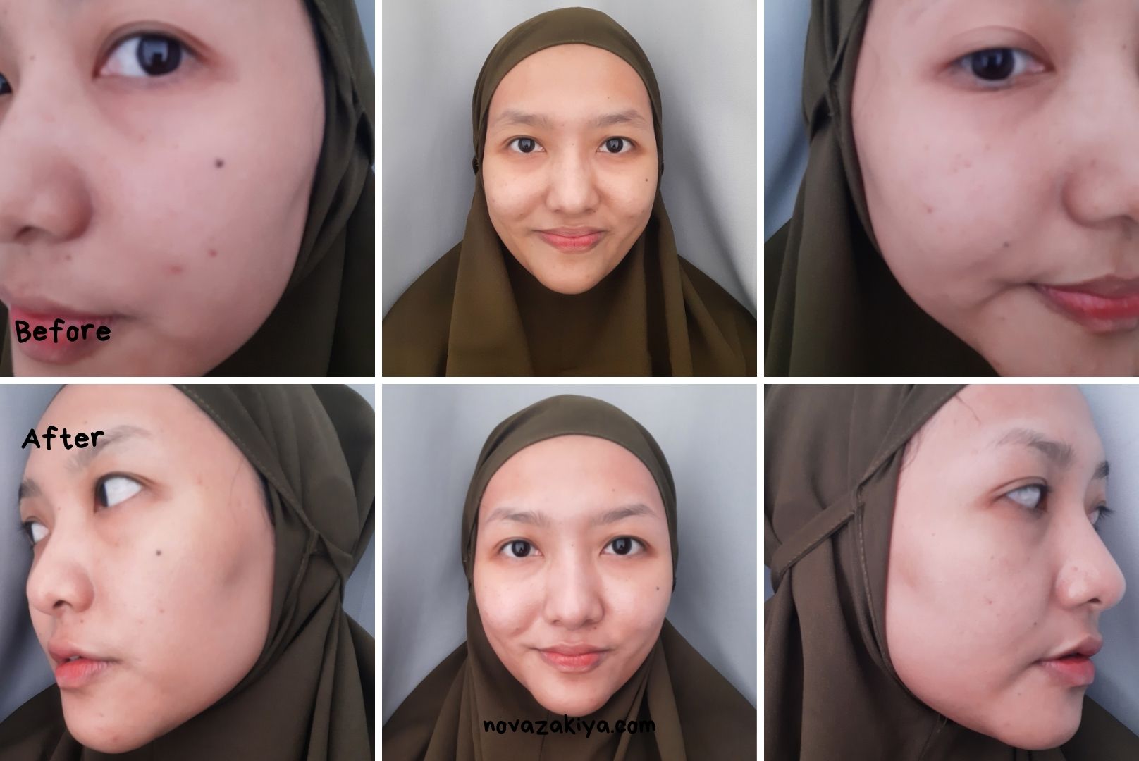 Before After Pemakaian Innertrue Hyaluronic Ampoule