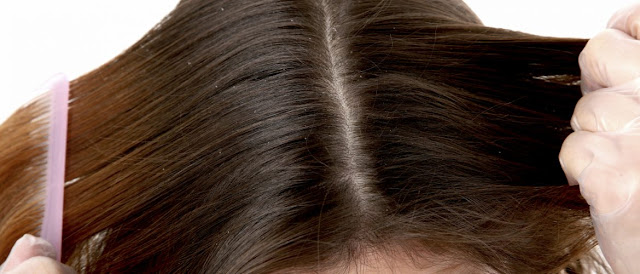 Have dandruff-Free Scalp From Color-Treated Hair