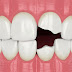 Bọc răng sứ có hiệu quả với răng sâu nặng không?