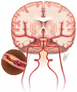 Cara Mengobati Penyakit Stroke