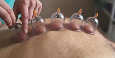 Hijama,Treatment by hijama,hijama for sciatica nerve,benefits of cupping for sciatica,Hijama For Sciatic Nerve,hijama therapy,blog,Cupping for Sciatic  nerve