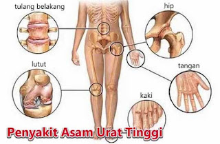 cara menyembuhkan asam urat dengan cepat, efek kekurangan asam urat, bolehkah penderita asam urat makan cincau, cara menyembuhkan asam urat secara alami, ciri asam urat di kaki, penatalaksanaan farmakologi asam urat, obat herbal alami atasi asam urat, ikan yang boleh dikonsumsi penderita asam urat dan kolesterol, angka normal asam urat wanita, obat tradisional untuk penyakit kolesterol dan asam urat, cara mengobati asam urat dengan cepat dan alami, cara menghilangkan sakit akibat asam urat, asam urat makan ayam, komposisi asam urat super, ciri asam urat dan obatnya, tanda asam urat dan pencegahannya, cara mengatasi rasa sakit akibat asam urat, khasiat bawang putih untuk obat asam urat, cara alami utk mengobati asam urat, obat apotik penyakit asam urat, obat pereda rasa sakit asam urat, cara ampuh mengobati asam urat, pemeriksaan kadar asam urat darah, pantangan sakit asam urat dan kolesterol, pengaruh asam urat ke ginjal, cara mengatasi asam urat atau kolesterol, makanan untuk mengobati asam urat dan kolesterol, asam urat di leher, cara sehat menurunkan asam urat, obat asam urat yg generik