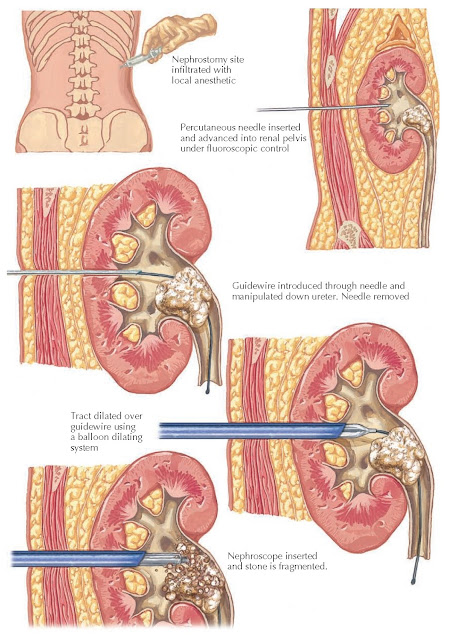 PERCUTANEOUS NEPHROLITHOTOMY: CREATION OF ACCESS TRACT