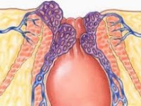 Cara Cepat Mengobati Benjolan Ambeien Hemoroid 