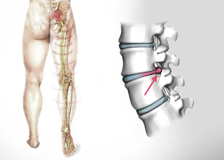 A importância dos Discos da Coluna Vertebral