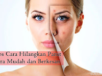 Cara Hilangkan Bekas Jerawat Hitam Di Muka