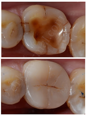 Tabletop Restoration for Attrition of Tooth