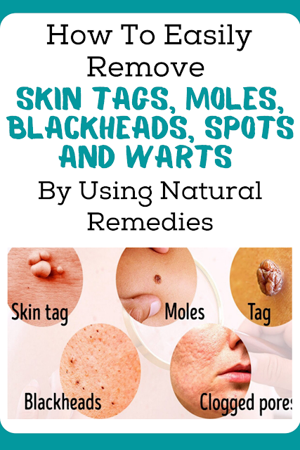 How To Easily Remove Skin Tags, Moles, Blackheads, Spots And Warts By Using Natural Remedies