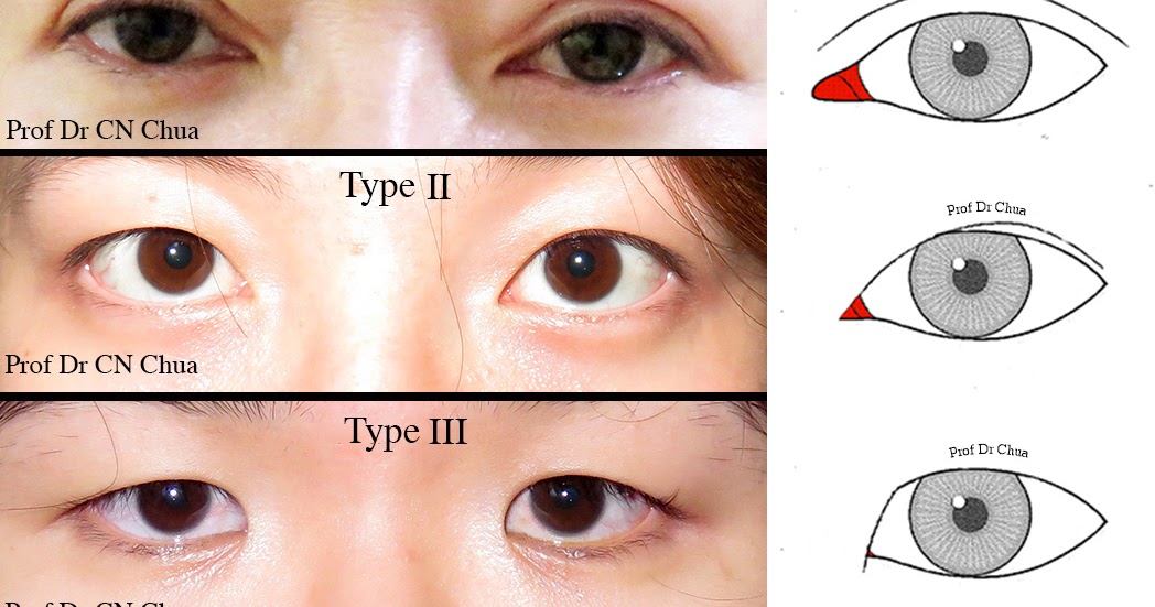 Eyelid Surgery By Prof Dr Cn Chua 蔡鐘能 Doc Do I Need Operation