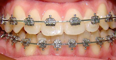 Các loại hình niềng răng người lớn hiệu quả