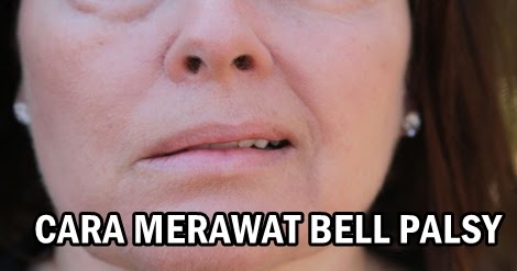 CARA MERAWAT BELL PALSY SUPAYA KEMBALI SENYUM DENGAN CERIA 